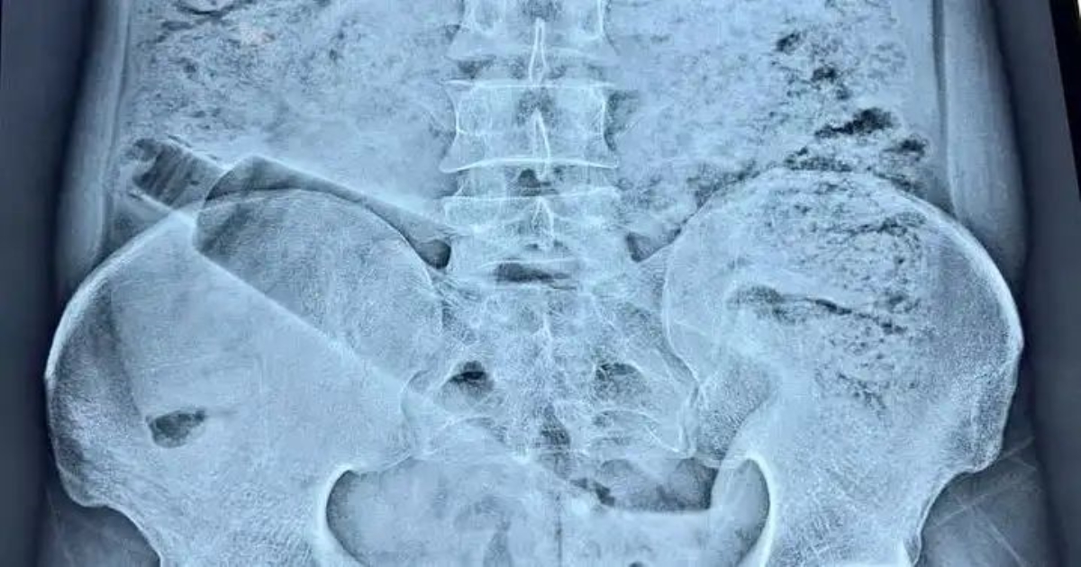 plastic-bottle-stuck-in-man-rectum-ahmedabad-surgery