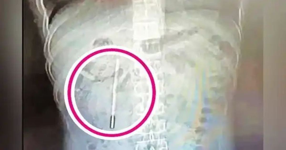 china-man-thermometer-swallowed-surgery-after-20-years