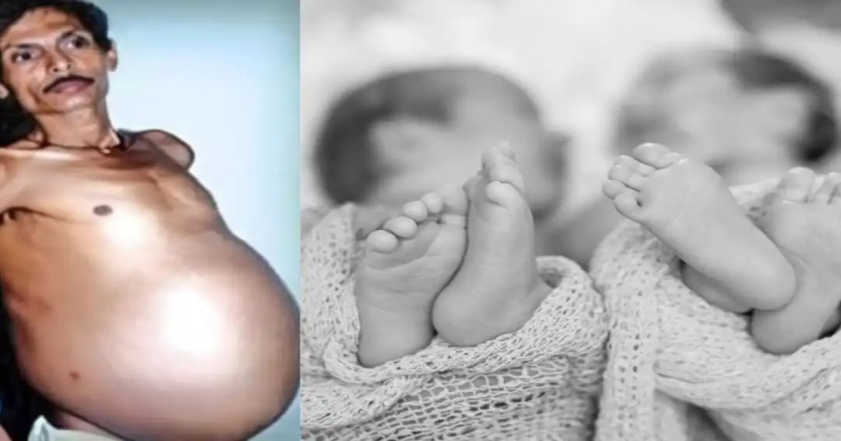 nagpur-man-lived-with-twin-inside-stomach