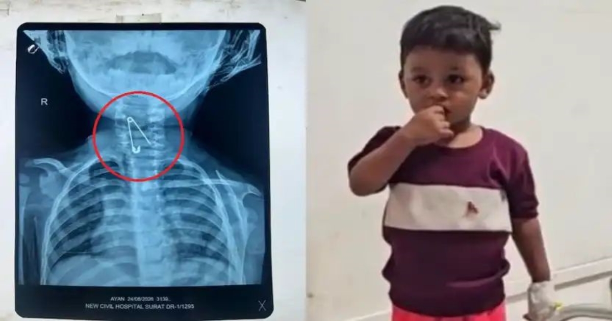 surat-toddler-swallows-open-safety-pin