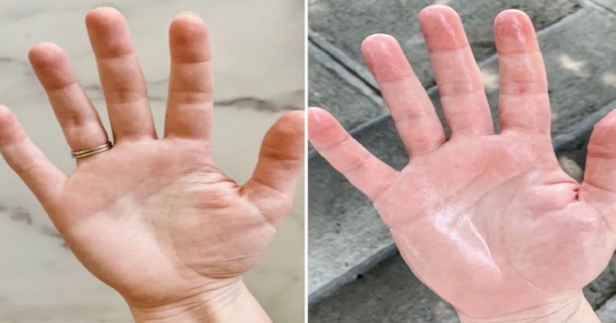 excessive-palm-sweating-causes-treatment-for-palmar-hyp