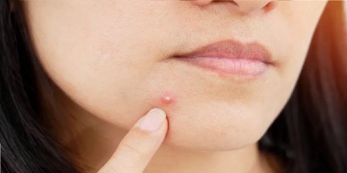 How to  remove pimples in one week