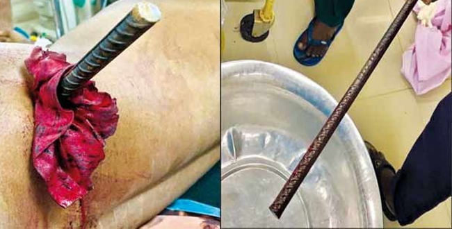 Iron rod entered from engineer back to stomach near Thanjavur