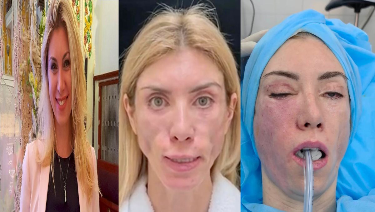 Russia Model Yulia Tarasevich Face Plastic Surgery Turns unable to close eyes or smile 