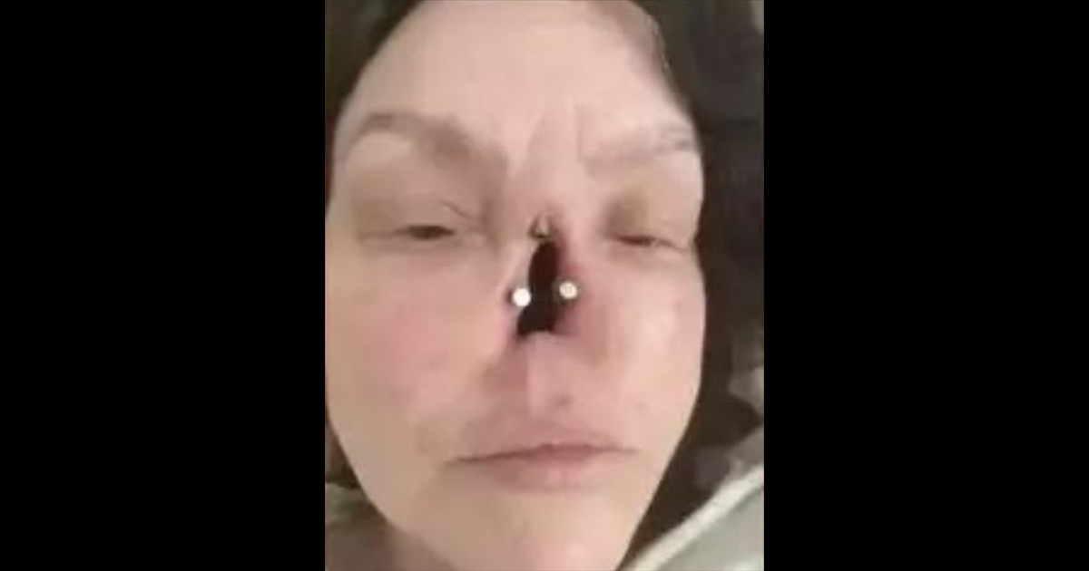 woman who lost her nose to cancer england