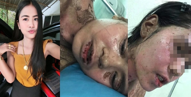 Horrific reaction to ibuprofen that left her burning from the inside out