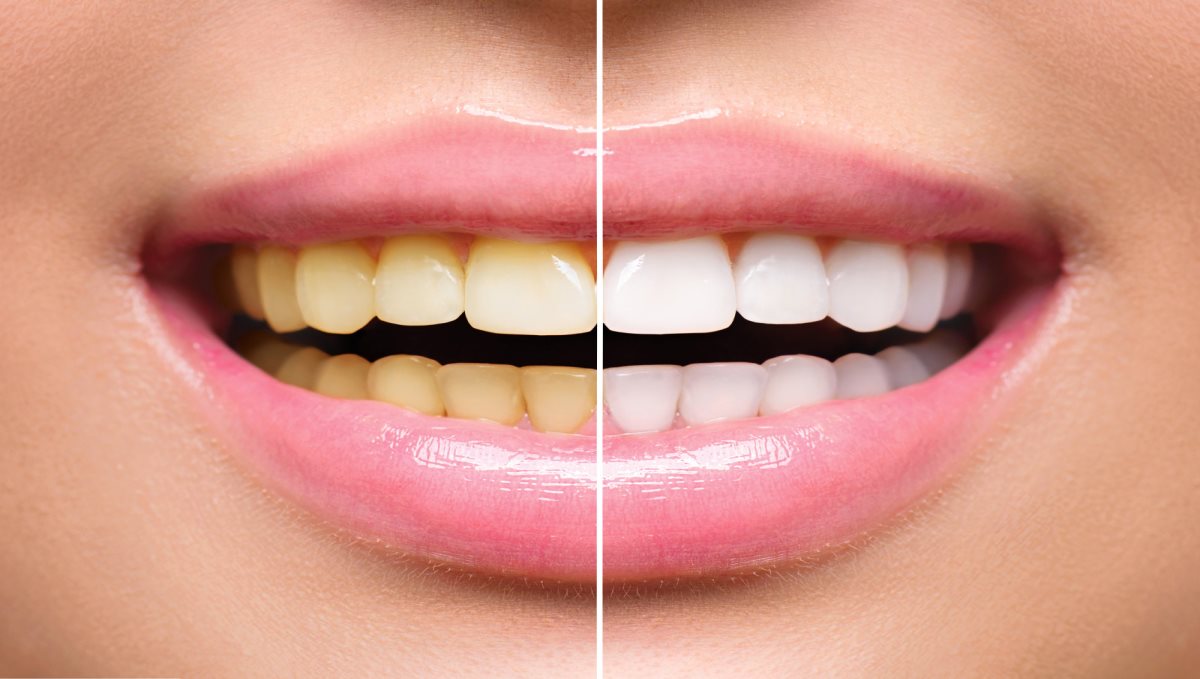 Teeth Whitening tips in Tamil