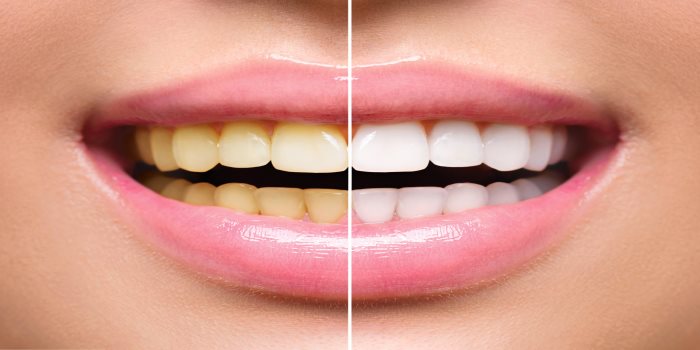 Tips for teeth whitening 