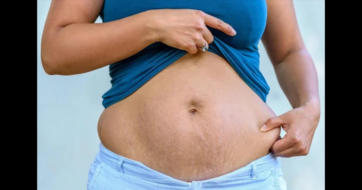 Do you want a flat stomach with no belly button after giving birth?... here it is for you..!!