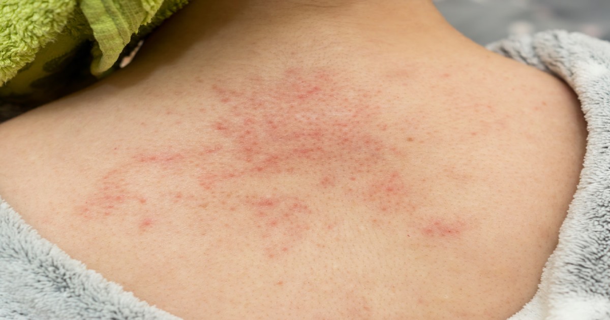 Summer Season heat Rash Viyarkuru avoid tips 