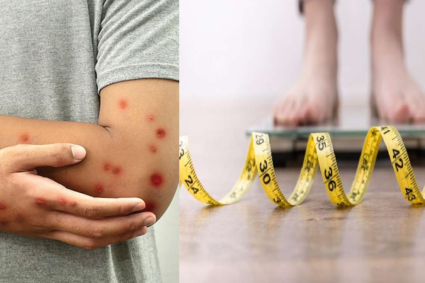 கோழித் தோல்