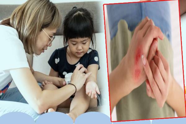 தீக்காயம் முதலுதவி