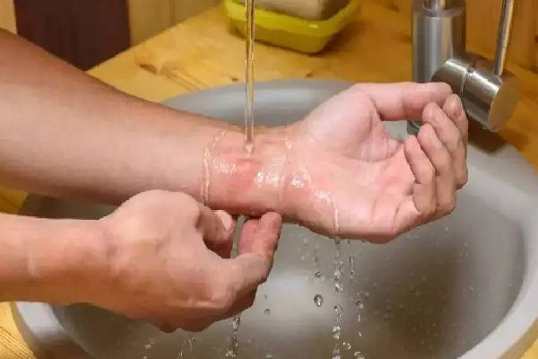 தீக்காயம் முதலுதவி