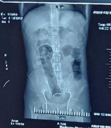 Perfume bottle in stomach