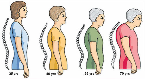 Osteoporosis