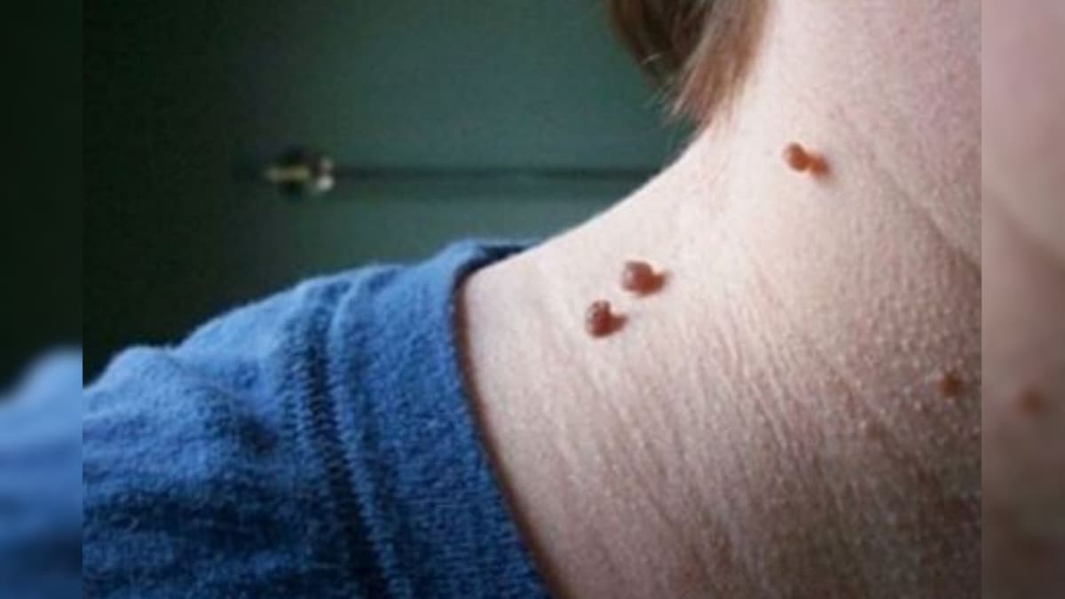 Skin Warts Removal