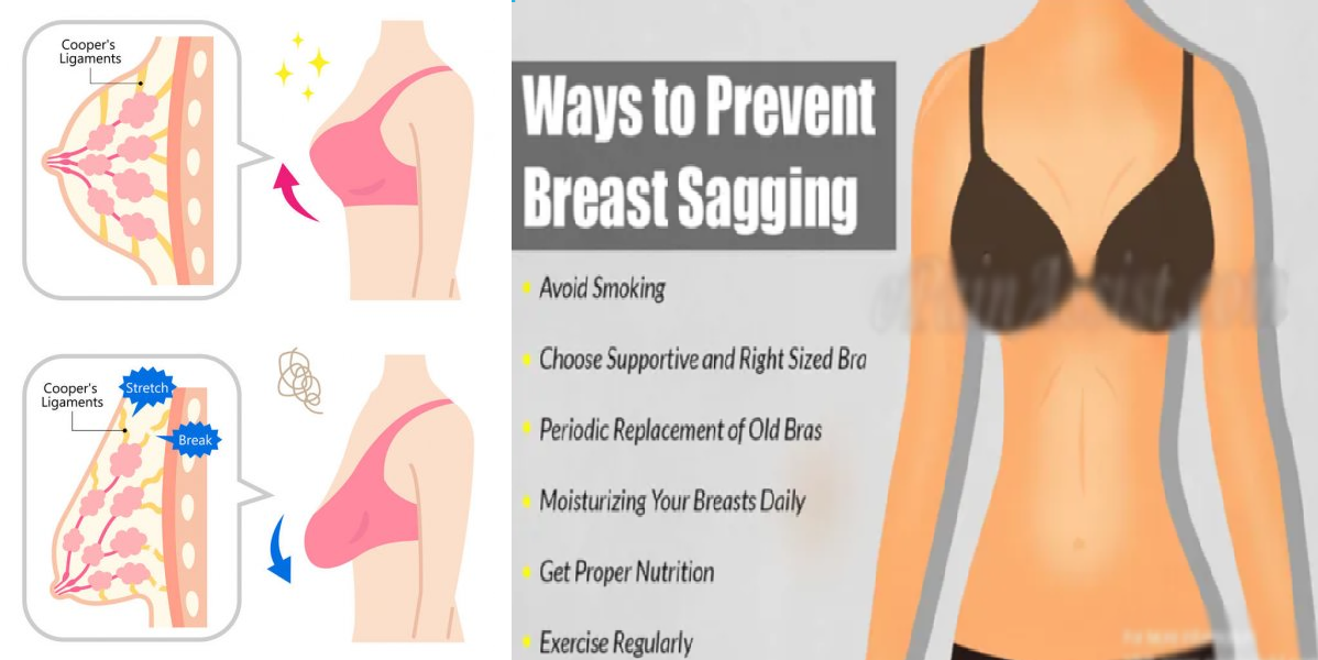 Breast Sagging