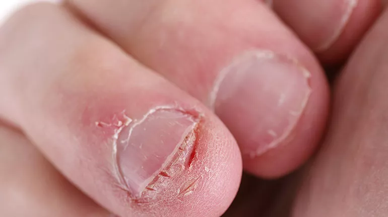 nail bite