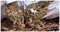 Tree-man-disease-epidermodysplasia-verruciformis