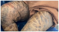 Lamellar-ichthyosis-skin-disease-treatment