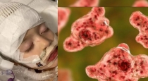 a-2-year-old-child-died-of-an-amoeba-disease-that-attac