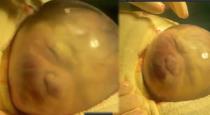 Baby born inside fully intact amniotic sack