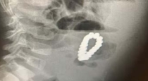 4 years old boy stomach inside magnetic bracelet doctor shock