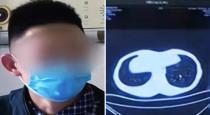 Chinese man who gobbled live snakes now has lungs riddled with worms