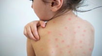 Chickenpox and monkeypox spreading fast in tamilnadu 