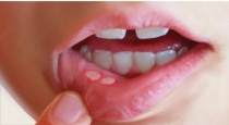 Easy tips mouth uler remedies 