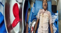 in Karnataka Uttara Kannada Boy Dies Balloon Stuck into Throat 