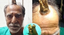 Madhya-pradesh-man-devils-horn-rare-surgery-case