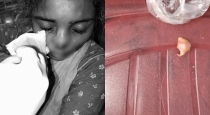 Telangana-dowry-husband-attacks-wife-nose