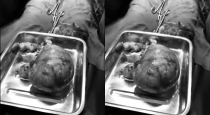 28-year-old-woman-large-uterine-fibroid