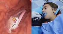 Girl-hair-clip-swallowed-endoscopy-video