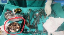 Karnataka Raichur Man Eats Coin 187 Removed After Doctors surgery 