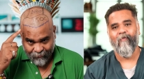 Chennai Hair Transplant Scam Unqualified Teenagers Performing Surgery, Customers at Risk