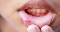 home-remedies-for-mouth-ulcer