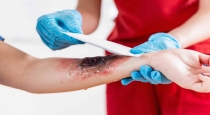 First-aid-for-burns-home-safety-tips