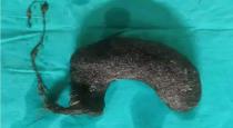 500 gram hairball removed from girl’s stomach  Read more at: http://timesofindia.indiatimes.com/articleshow/87212937.cms?utm_source=contentofinterest&utm_medium=text&utm_campaign=cppst