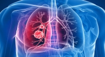 lung-cancer-early-signs-finger-clubbing