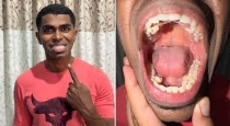 Malaysia-man-with-42-teeth-guinness-world-record