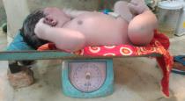 Assam baby weighs 5.2 kg at birth