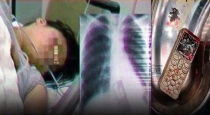 a-19-year-old-girl-who-swallowed-her-cell-phone-and-cri