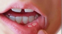 Home remedies for mouth ulcer 