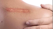 Why woonds getting itching while relaxing