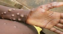 england-confirm-nigeria-return-man-affect-chickenpox