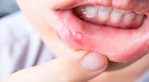 Winter Cold Triggers Rise in Mouth Ulcers and Dehydration 