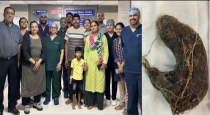 ahmedabad-trichobezoar-surgery-2025