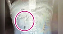 China-man-thermometer-swallowed-surgery-after-20-years